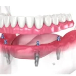 Considering Full Mouth Dental Implants? What You Need to Know