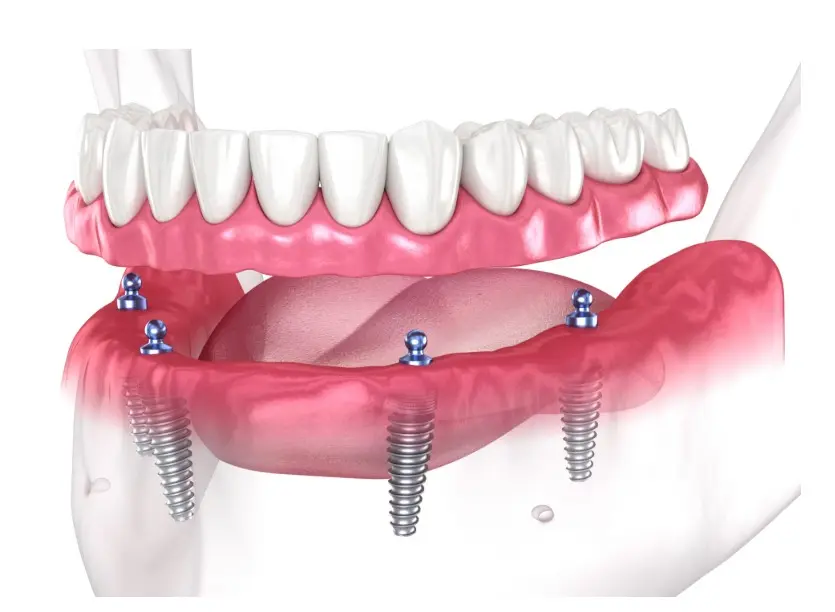 Considering Full Mouth Dental Implants? What You Need to Know