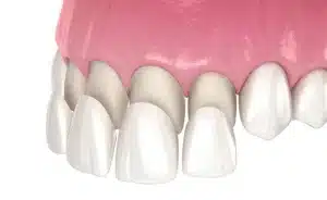 Transform Your Smile with High-Quality Porcelain Veneers in Brisbane