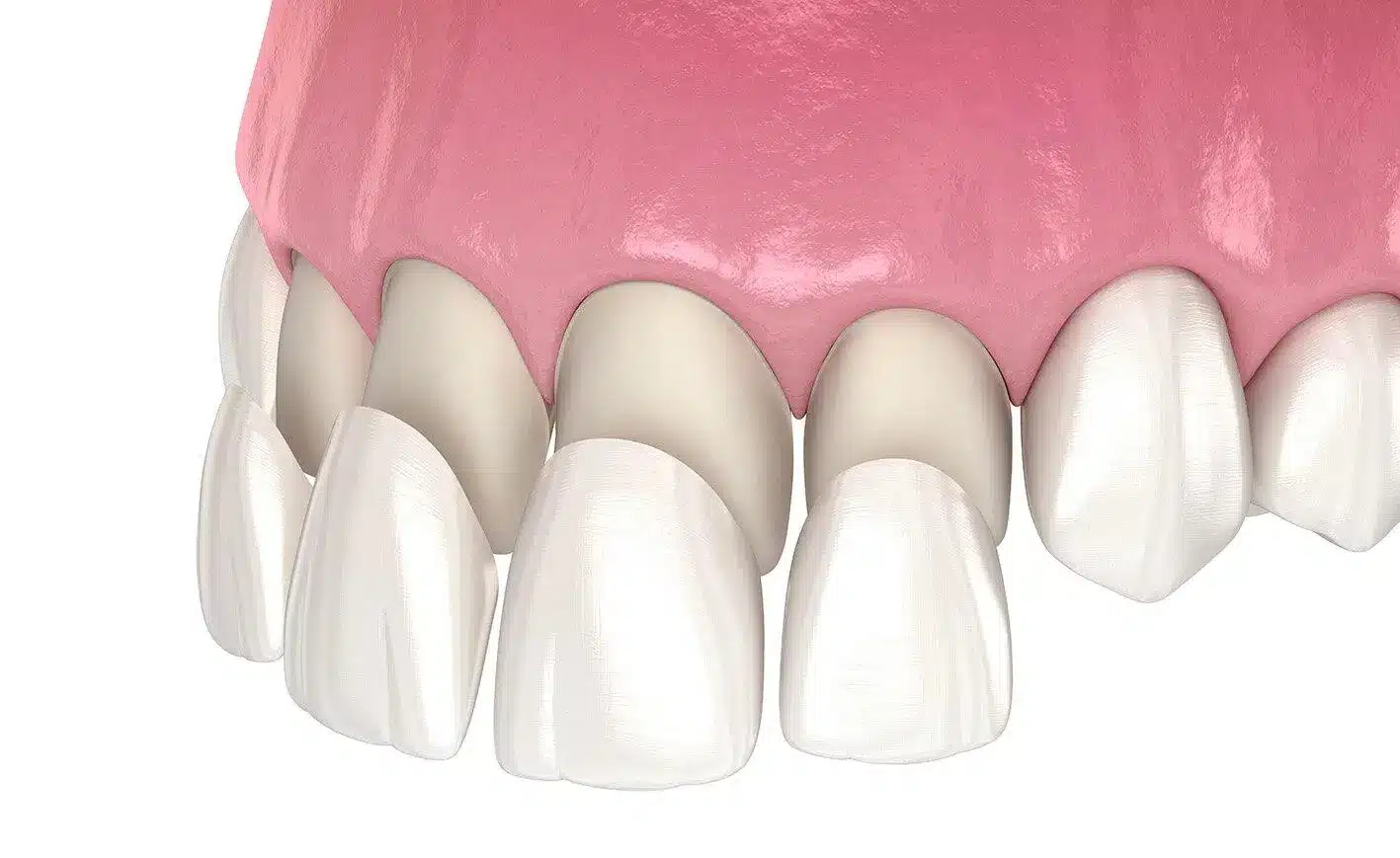Transform Your Smile with High-Quality Porcelain Veneers in Brisbane