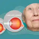 Clarity in Sight: Understanding the Benefits of Modern Cataract Surgery
