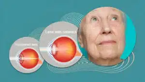 Clarity in Sight: Understanding the Benefits of Modern Cataract Surgery
