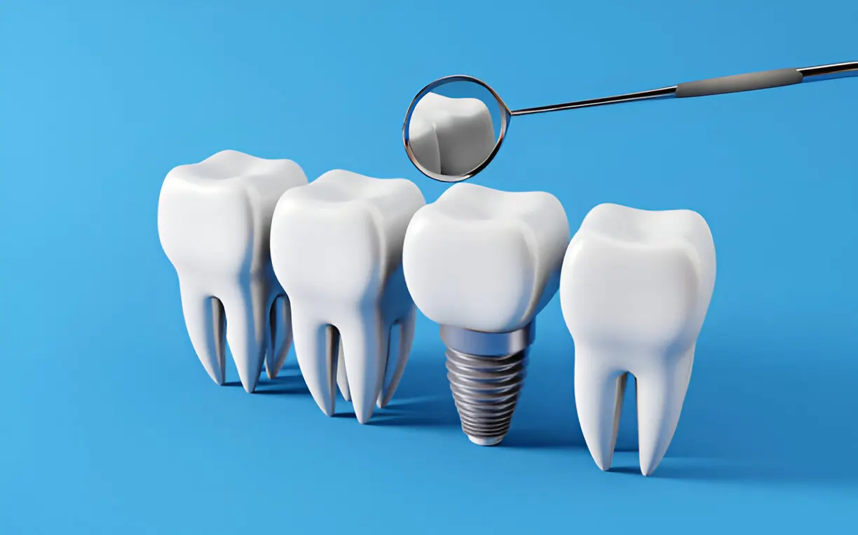 Discover the Life-Changing Benefits of Dental Implants Gateshead
