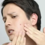 Answering the Age-Old Question: Do Acne Scars Go Away?