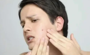 Answering the Age-Old Question: Do Acne Scars Go Away?