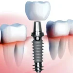 From Dentures to Digital Revolutionary Dental Implant Solutions for Complete Smile Restoration