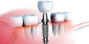 From Dentures to Digital Revolutionary Dental Implant Solutions for Complete Smile Restoration