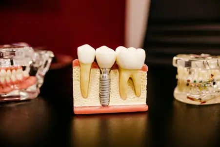 Why You Might Be a Perfect Candidate for Dental Implants - 4 Reasons