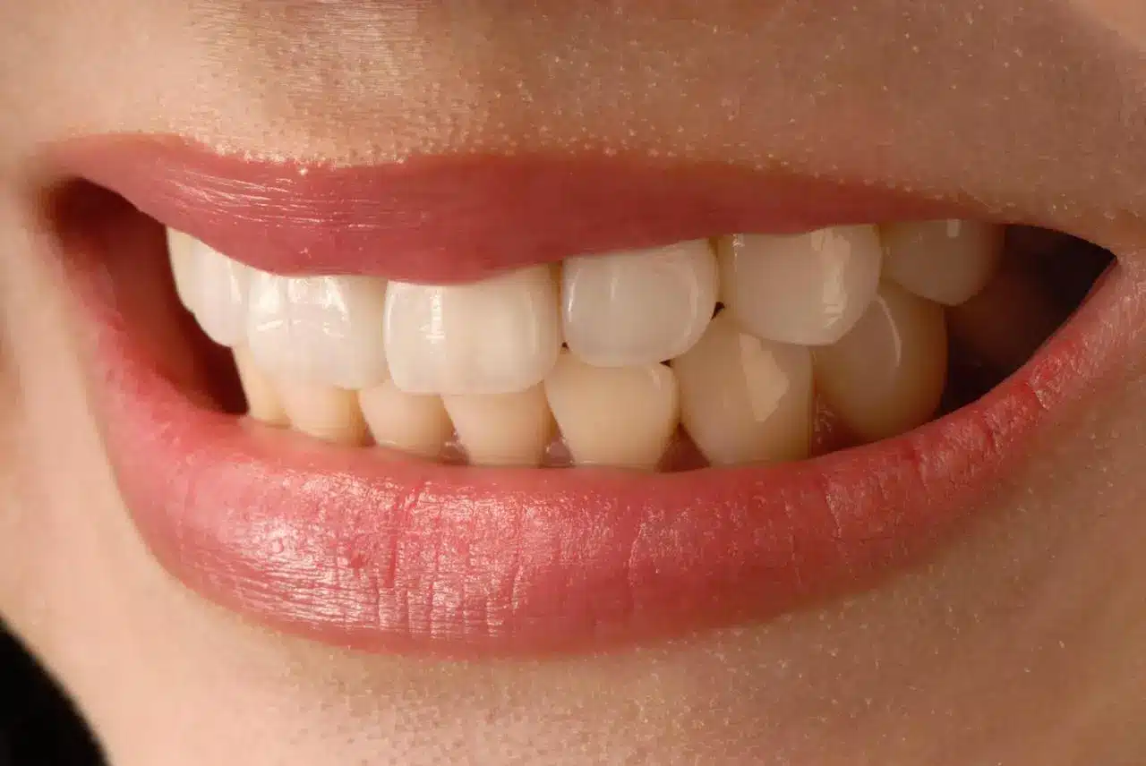Types of Veneers Choosing the Right Option for Your Smile