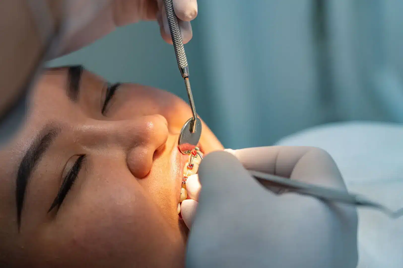 Dental Braces Options Traditional, Ceramic, and Invisible Aligners