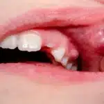 Why You Can't Open Your Mouth Properly When a Tooth Is Infected