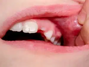 Why You Can't Open Your Mouth Properly When a Tooth Is Infected