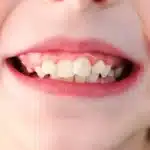 Crowded Teeth in Kids Causes Explained by Goodland Dentistry & Braces