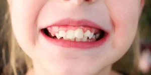 Crowded Teeth in Kids Causes Explained by Goodland Dentistry & Braces